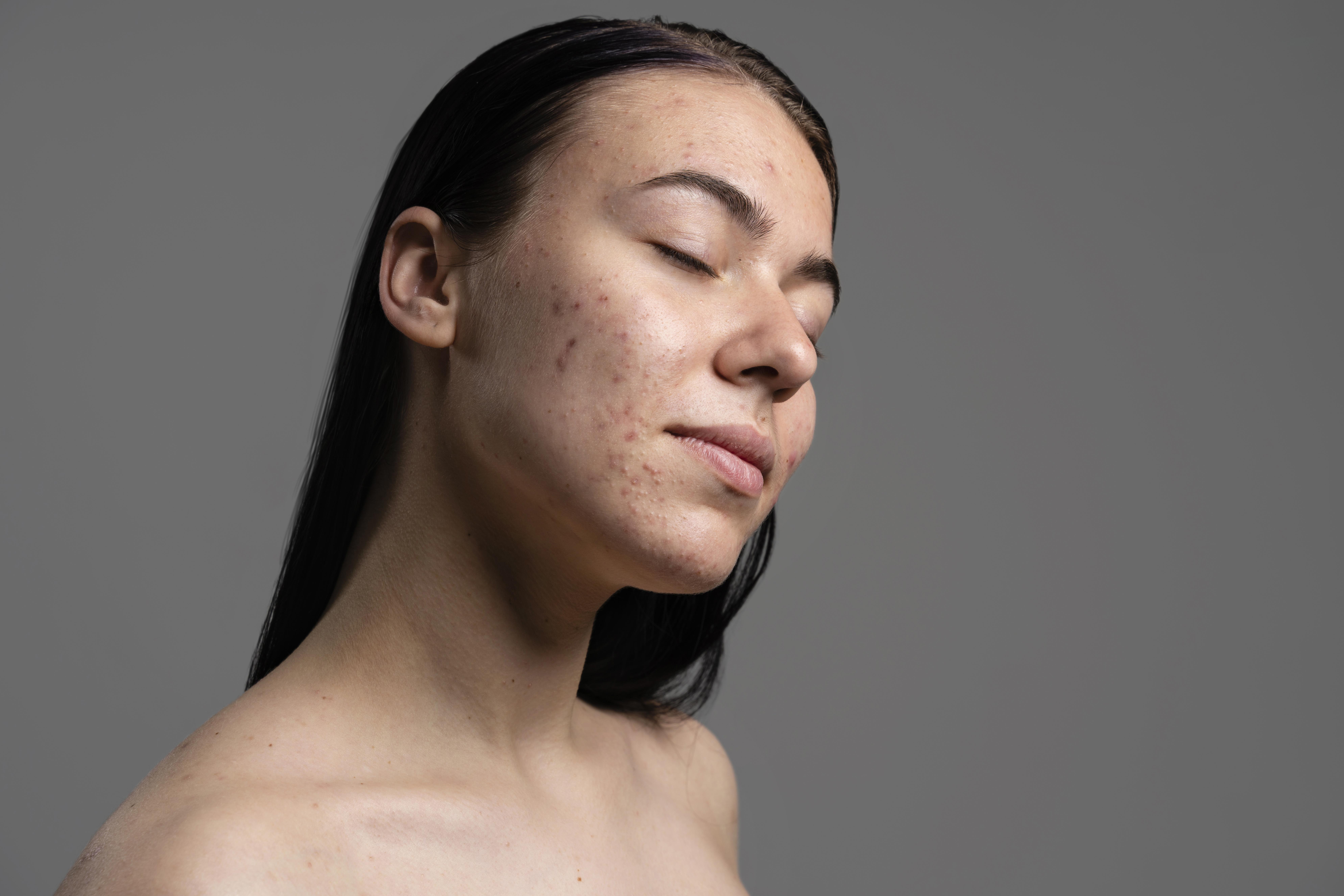 The Ultimate Guide to Treating Acne: Causes, Prevention & Best Treatments